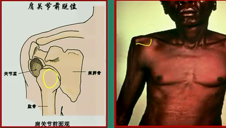 肩关节前脱位三种类型