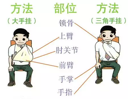 三角巾悬吊固定