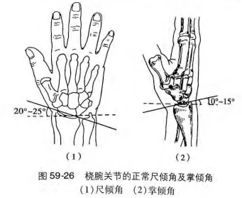 桡腕关节尺倾角和掌倾角