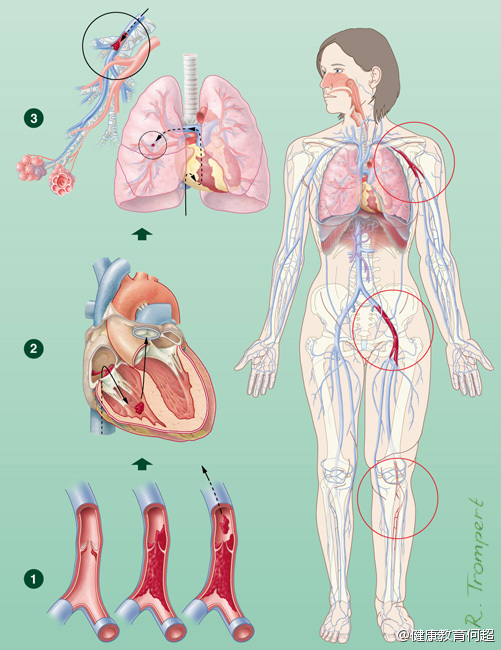 深静脉血栓形成DVT