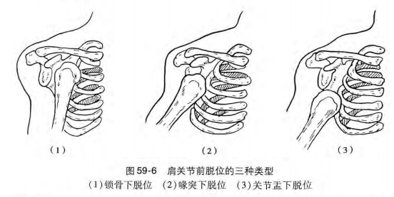 肩关节前脱位三种类型