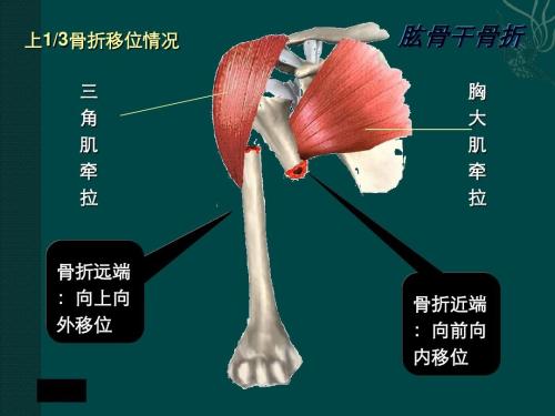 肱骨干骨折移位-三角肌止点上