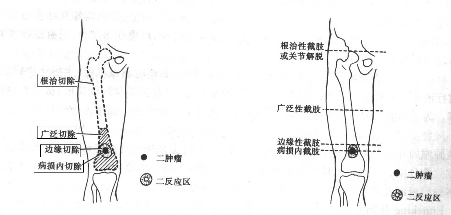 肿瘤切除缘概念